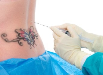 tatuajes en la columna vertebral puede ser un problema para el tratamiento con epidural