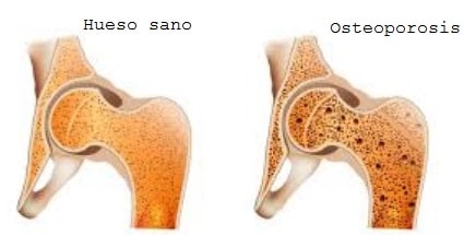 El papel del calcio y vitamina D en el tratamiento de la osteoporosis