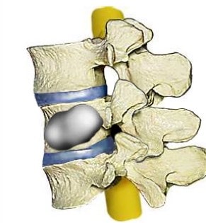 reparar vertebra rota