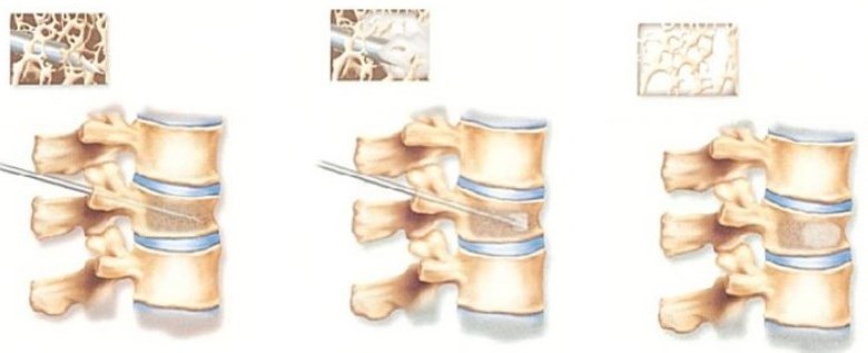 Vertebroplastia para tratar las fracturas vertebrales