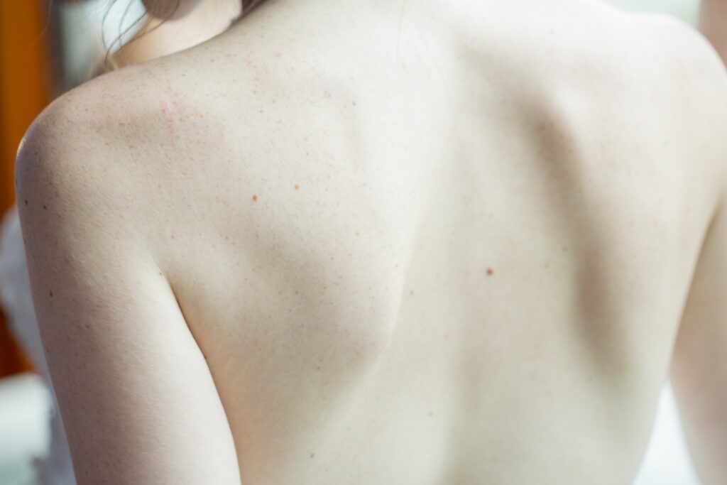 Príčiny vzhľadu hrudky na chrbte